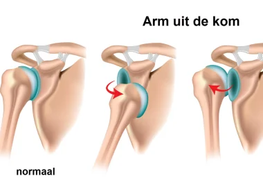 Schouderinstabiliteit, wat is dat precies?