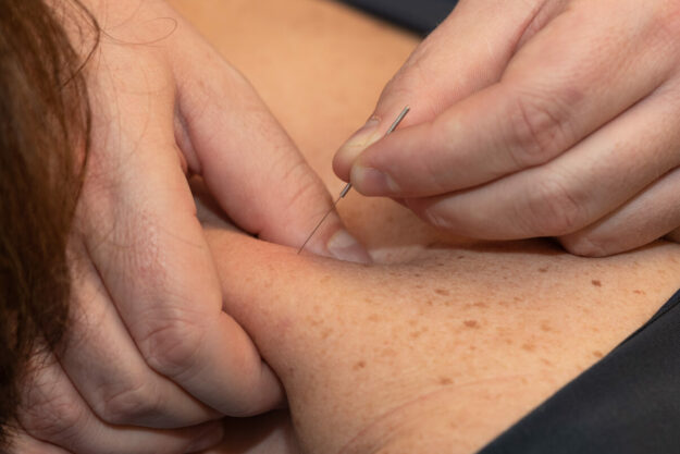 positieve effecten van dry needling positieve effecten van dry needling
